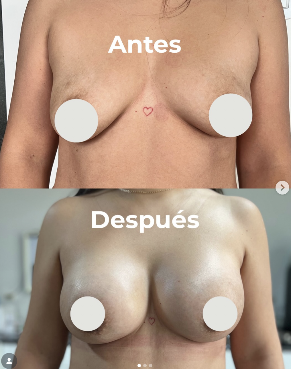 Aumento mamario resultado